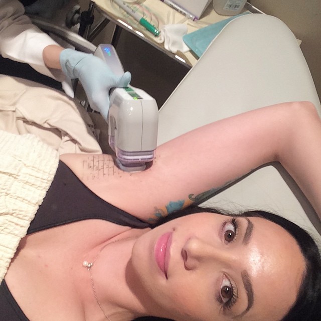 Goodbye underarm sweat!  Middle of my #MiraDry procedure!! Much easier than I was anticipating. I was filmed for their consultation/client education video